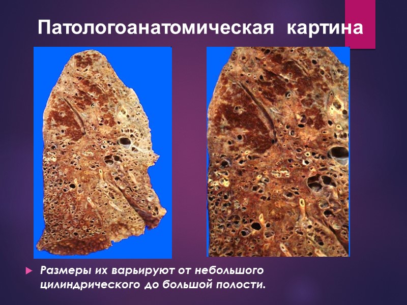 Патологоанатомическая  картина  Размеры их варьируют от небольшого цилиндрического до большой полости.